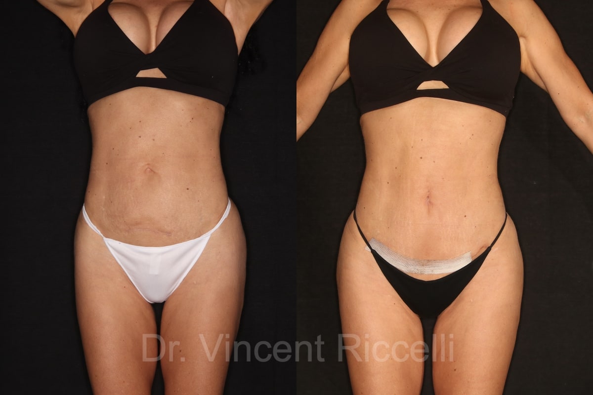 Front view: before and after mini-abdominoplasty, liposuction 360, and gluteal fat grafting with AlloClae by Dr. Vincent Riccelli.
